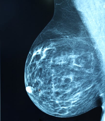 Should biannual MRIs replace annual mammograms in high-risk women?